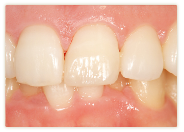 ラミネートべニア