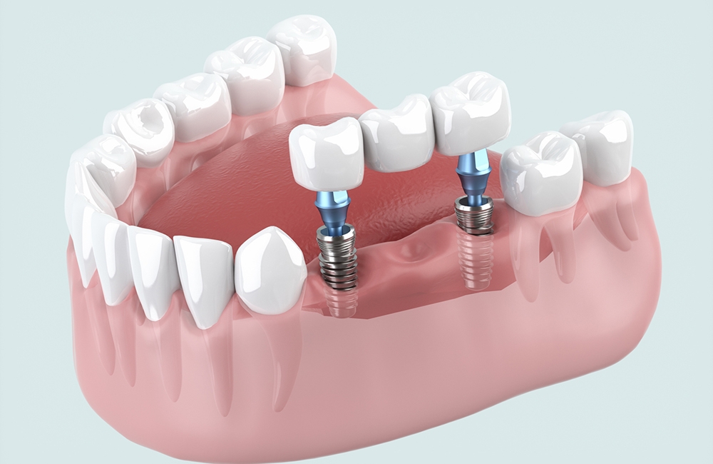 インプラント治療