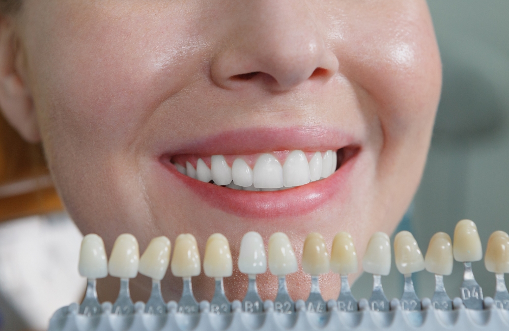 歯を削らずに白くするホワイトニング